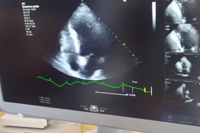 Se realizó el primer eco estrés en el Hospital de San Martín de los Andes